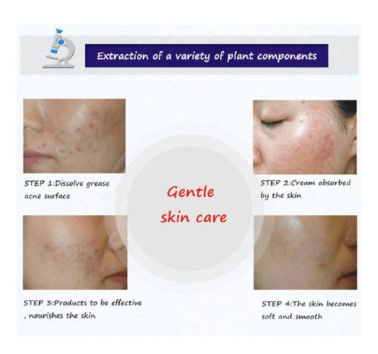 Bioaqua Anti Acne Cleanser For Removal Of Acne – 100ml-FlyingCart.pk