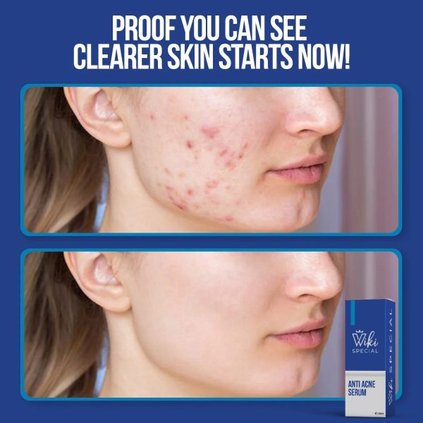 wiki-special-anti-acne-serum-30ml-clears-acne-soothes-skin-fights-blemishes-5-flyingcart.pk