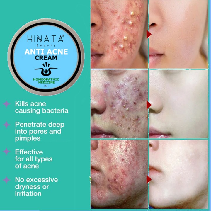 Hinata Anti Acne Cream