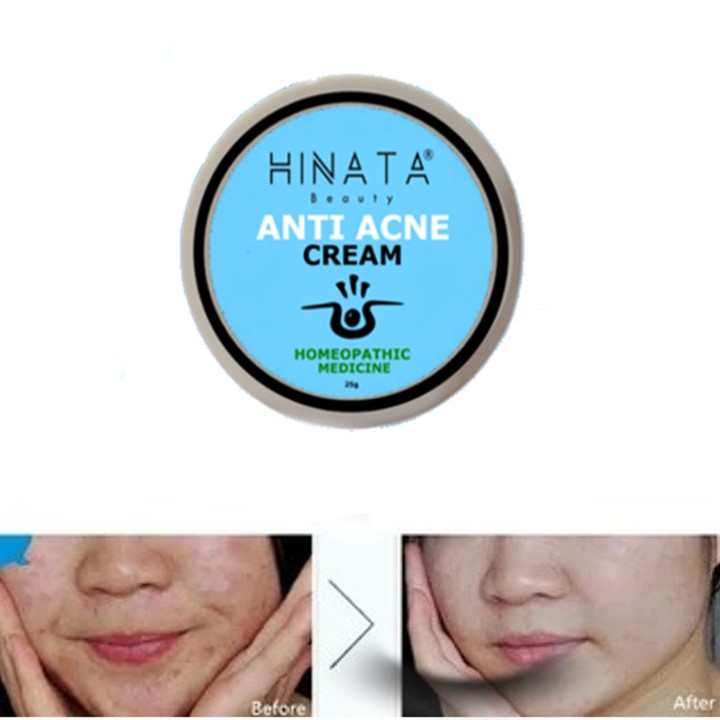 Hinata Anti Acne Cream